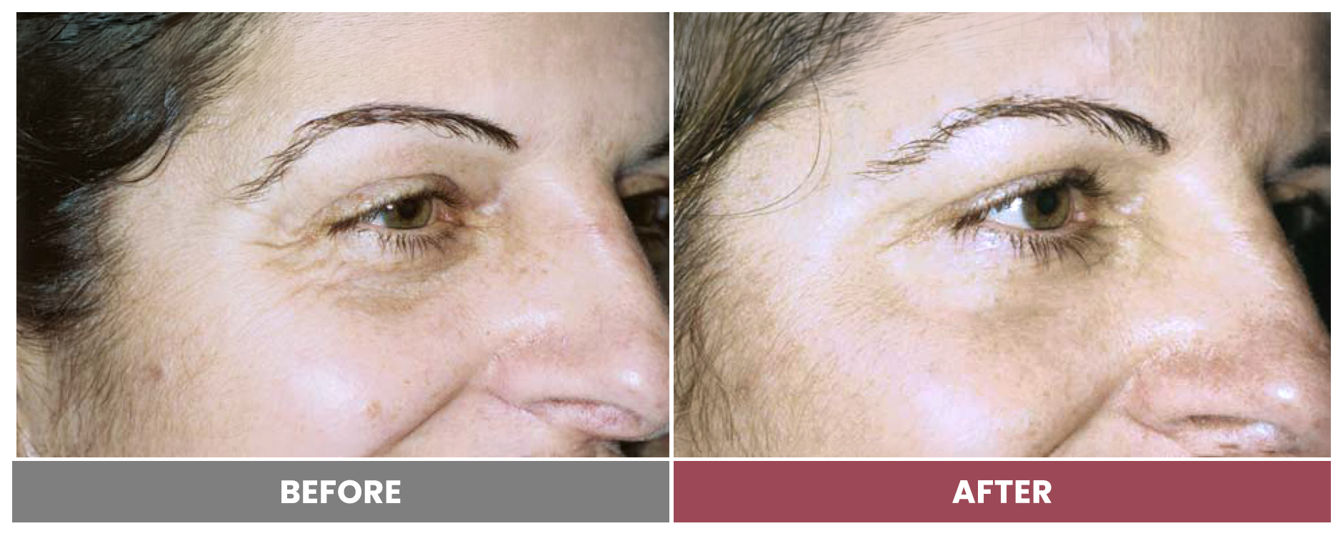 LASER SKIN RESURFACING - Case 4